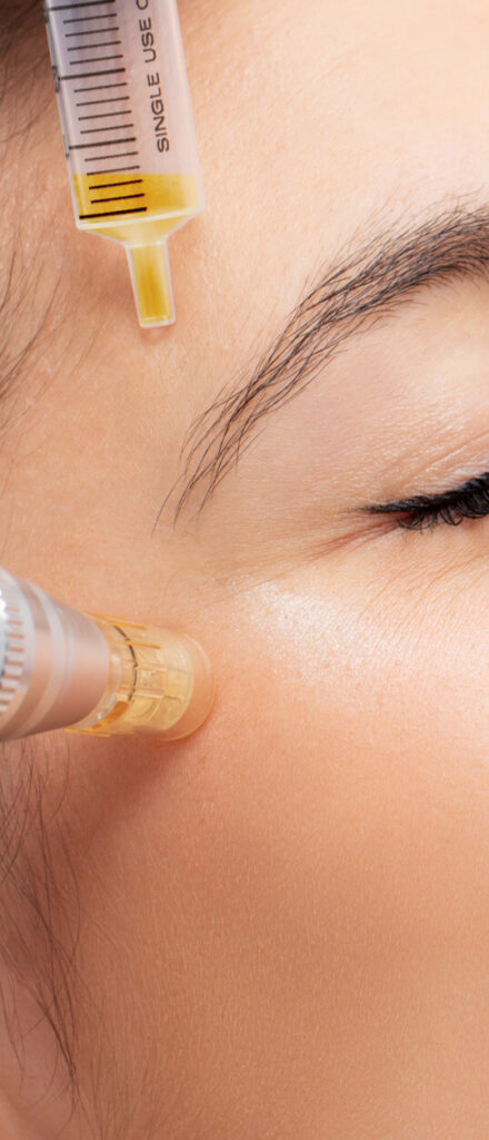 Micro needling in laser labs(1)