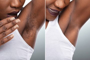 Hair removal one